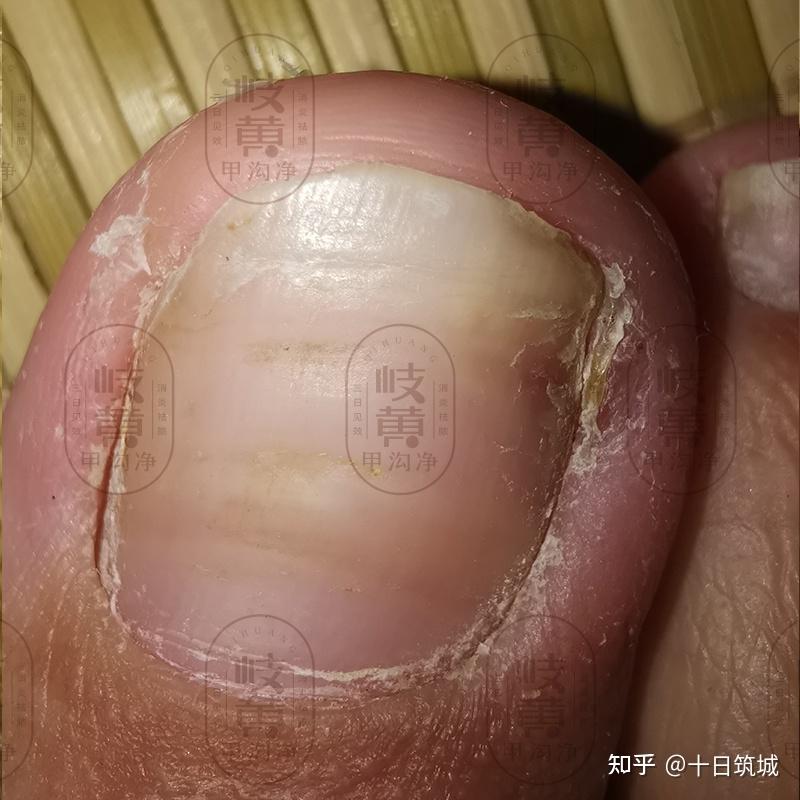 得了甲溝炎如何才能消除多餘的肉芽