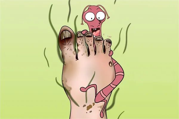 紫外线可以治疗灰指甲吗