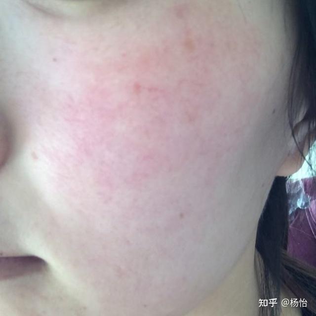 换季过敏 刺痛?泛红?痒?敏感肌真的太难了 - 知乎