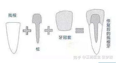 牙齿只剩牙根了,拔掉or留下?怎么处理? - 知乎