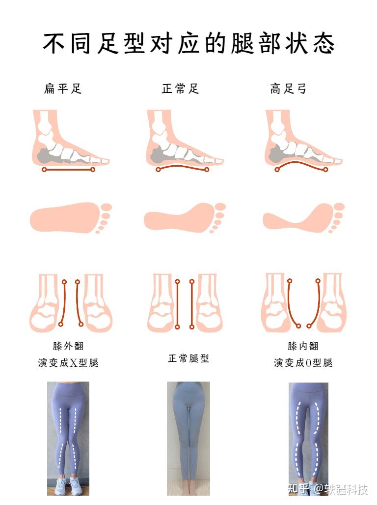 婴儿足内翻如何矫正