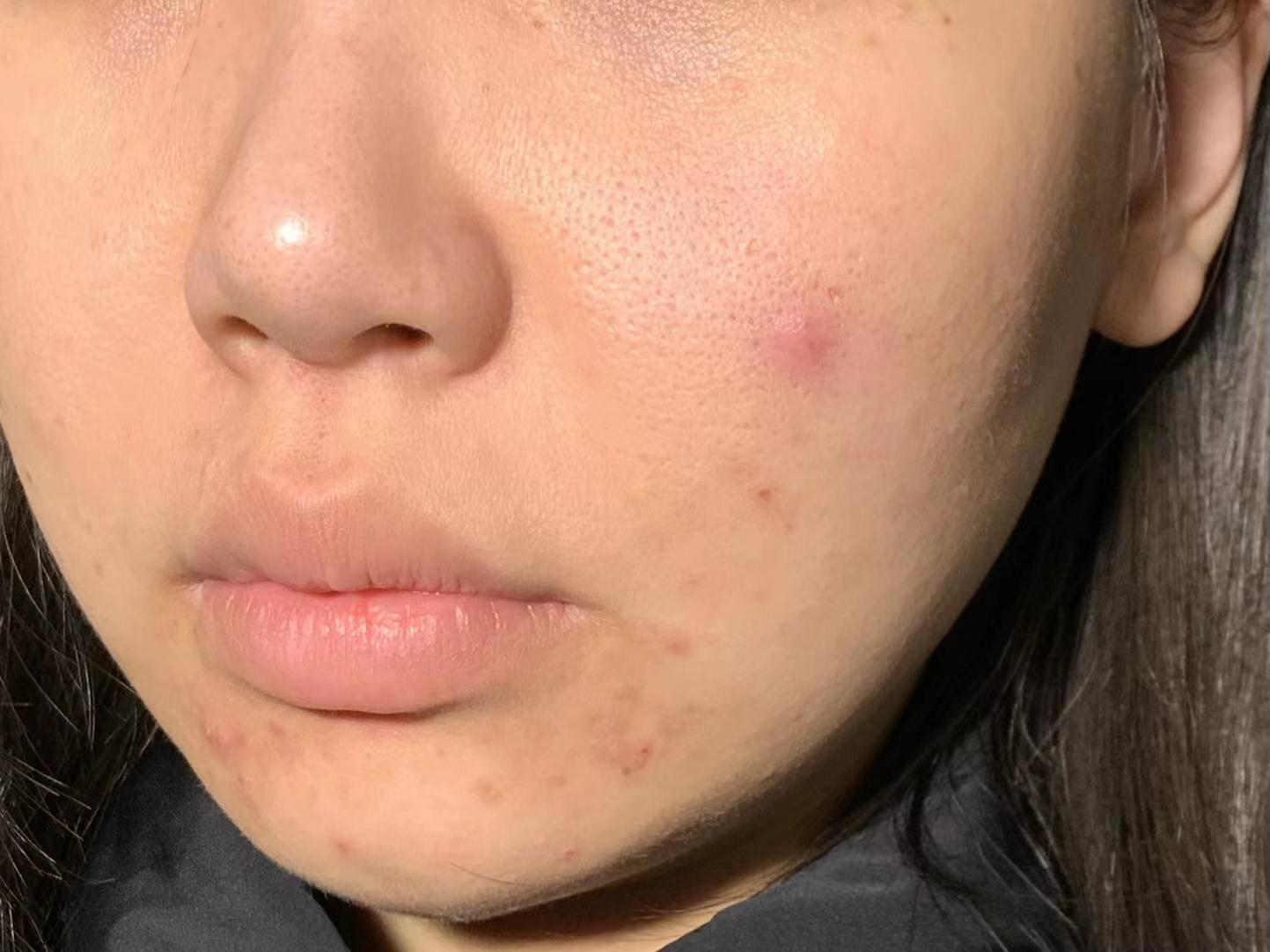 长痘痘化妆经常卡粉怎么办有没有什么推荐的护肤品和化妆品呀