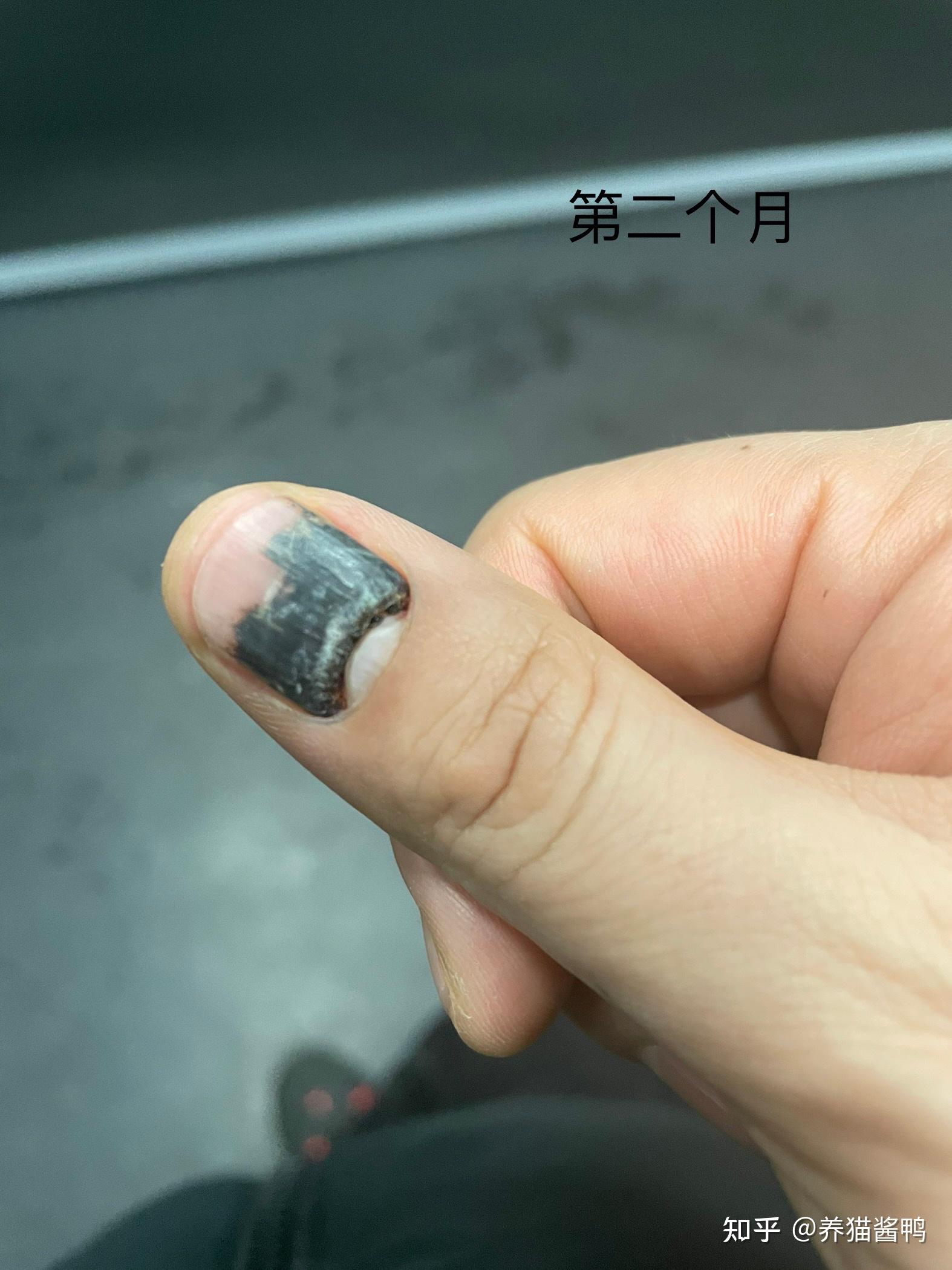 手指甲被砸上指甲里变黑怎么办 ? - 知乎