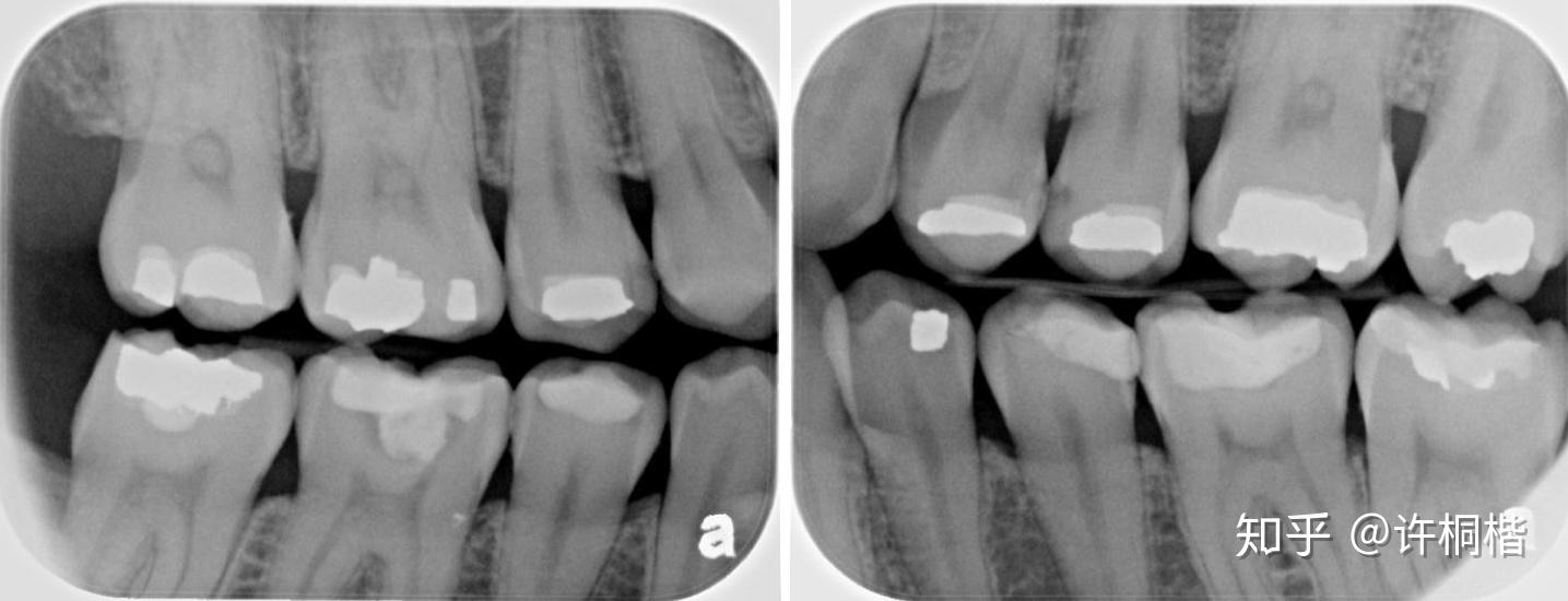如何发现成人邻面牙齿早期龋坏