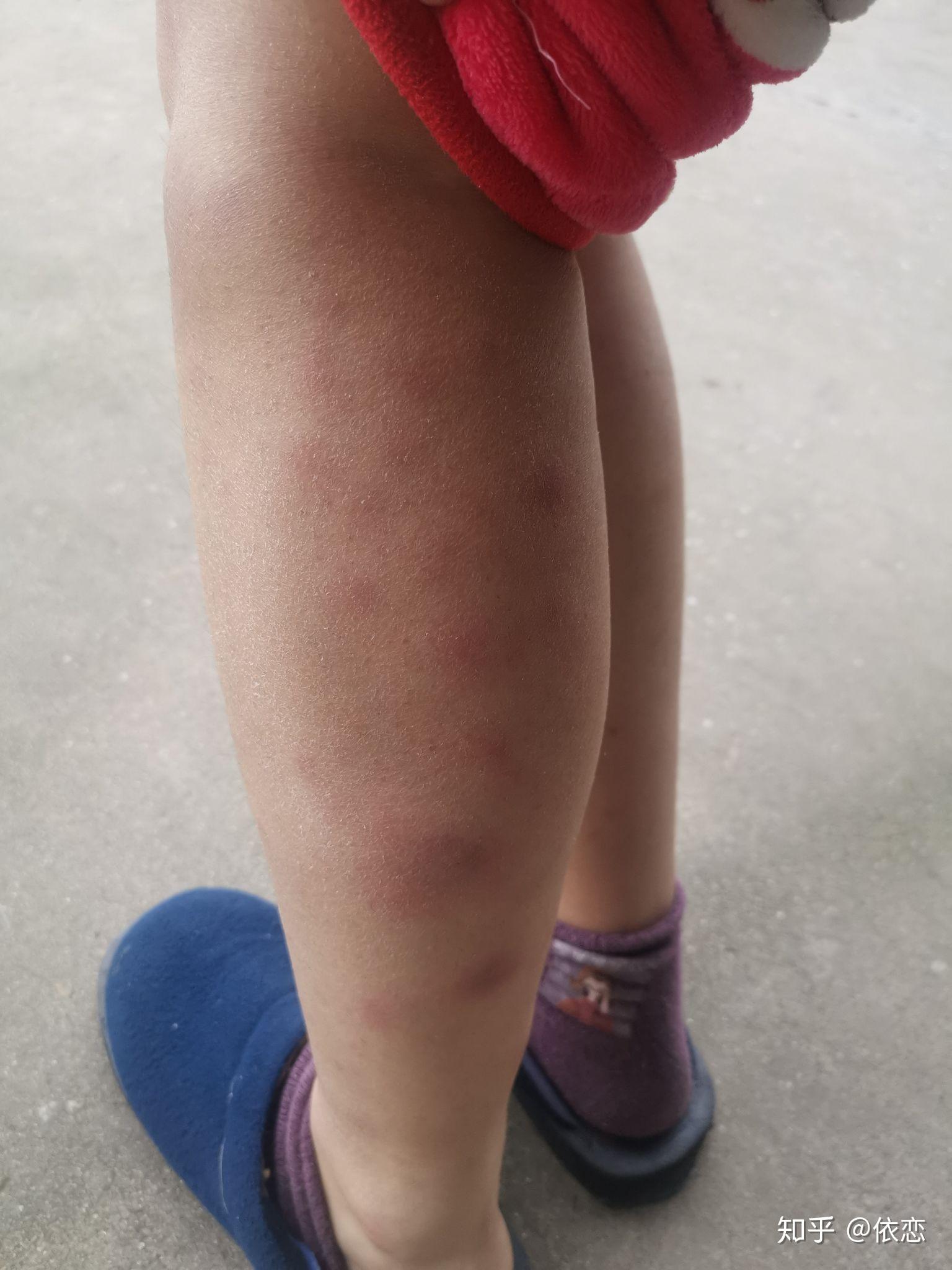 得过结节性红斑的人过来交流下