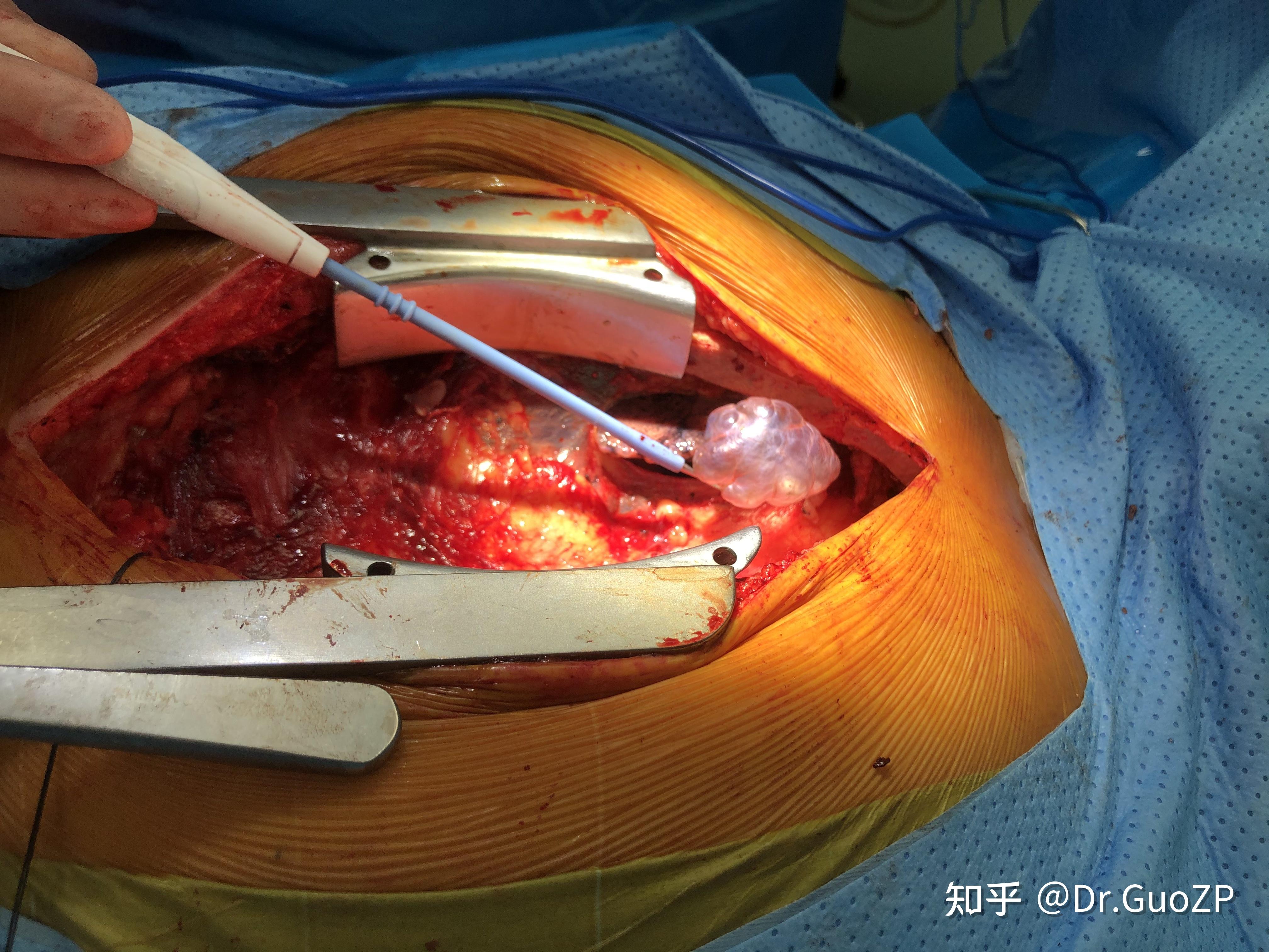 肺大疱切割手术属于什么手术手术前或入院前需要做什么检查