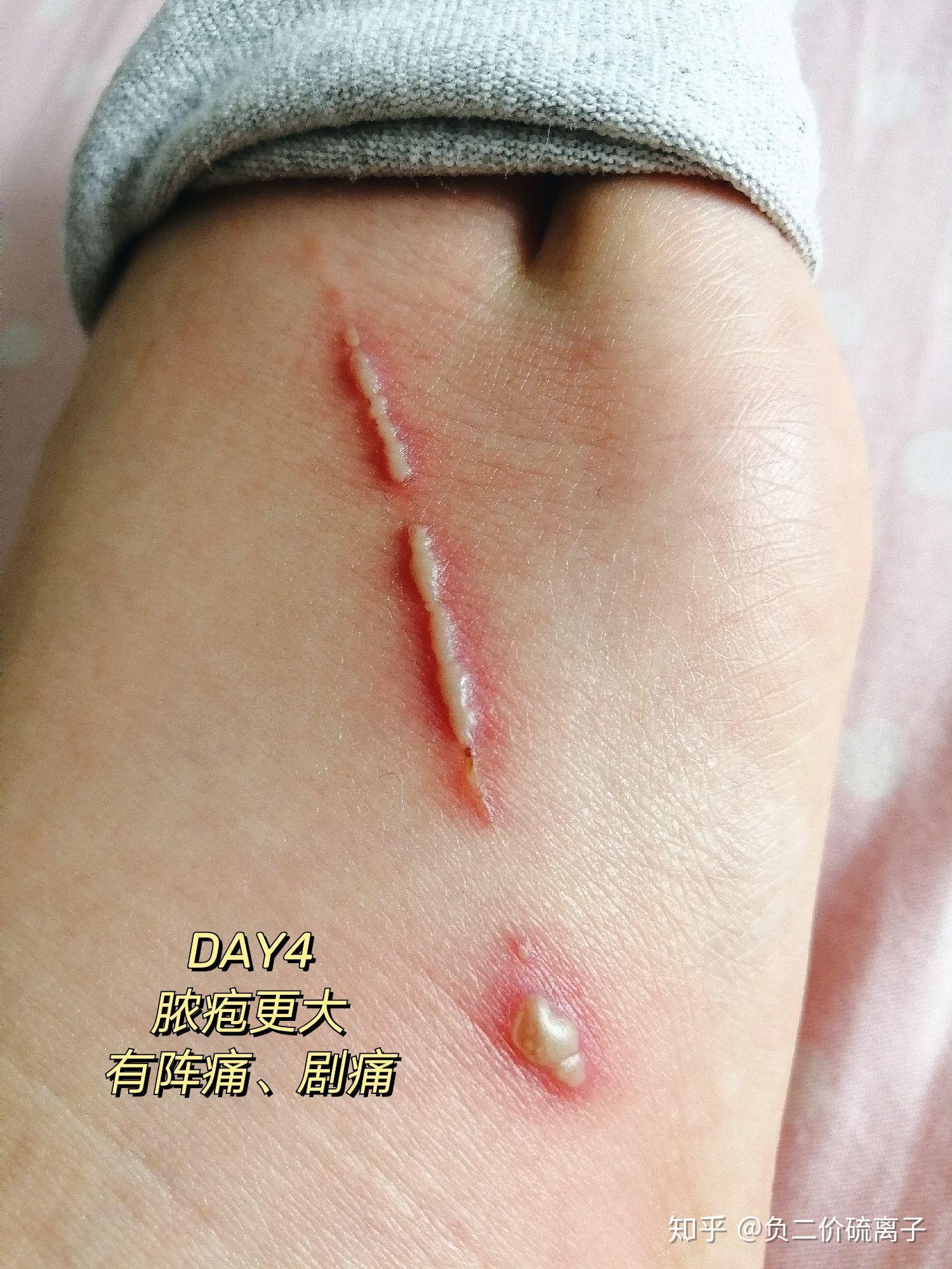 隐翅虫咬后的水泡能不能挤