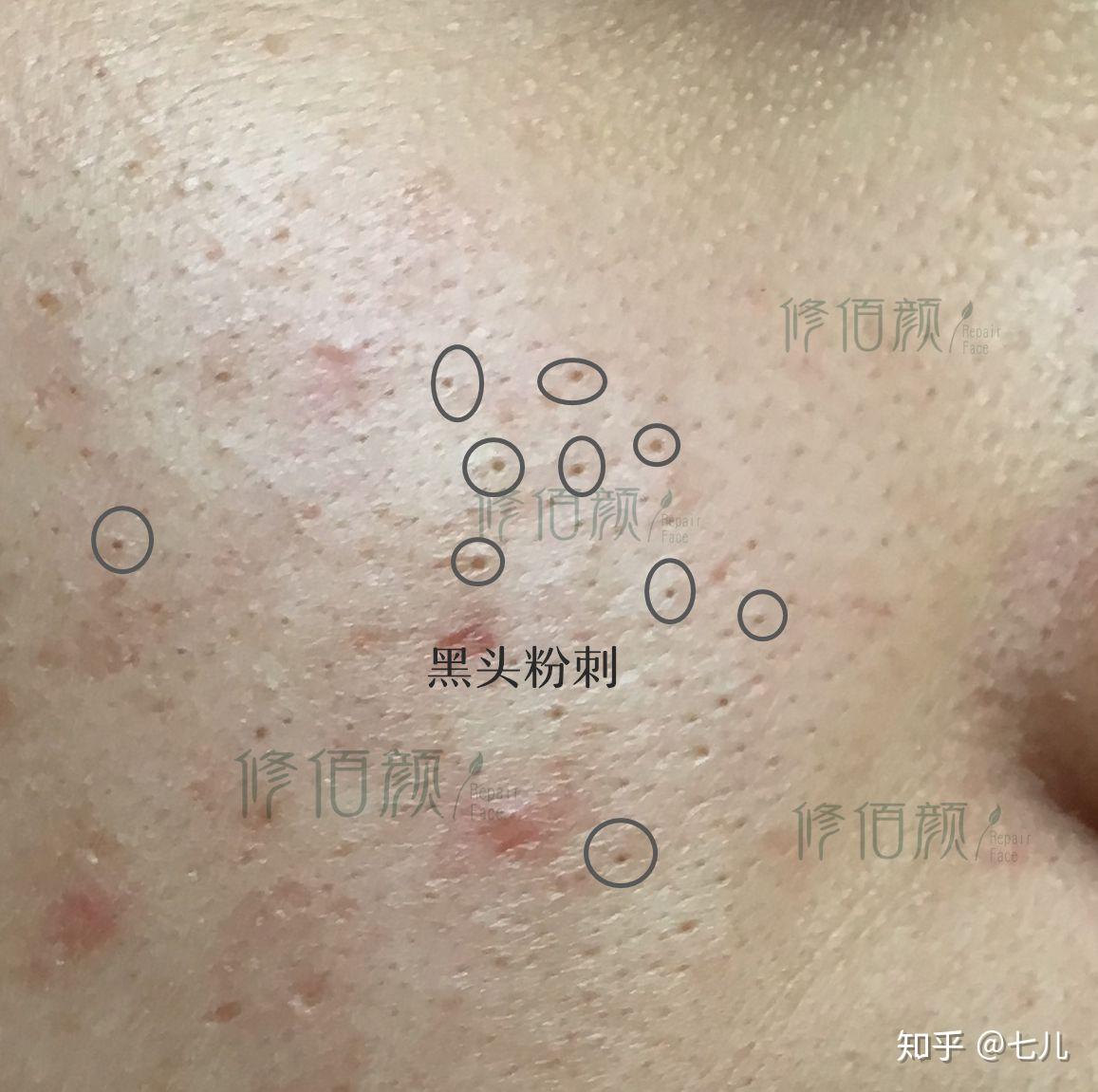 什么是粉刺,和闭口有什么区别? - 知乎