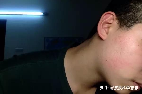 我是一個男生臉部腮部發紅不痛不癢不知道怎麼回事有什麼方法可以解決