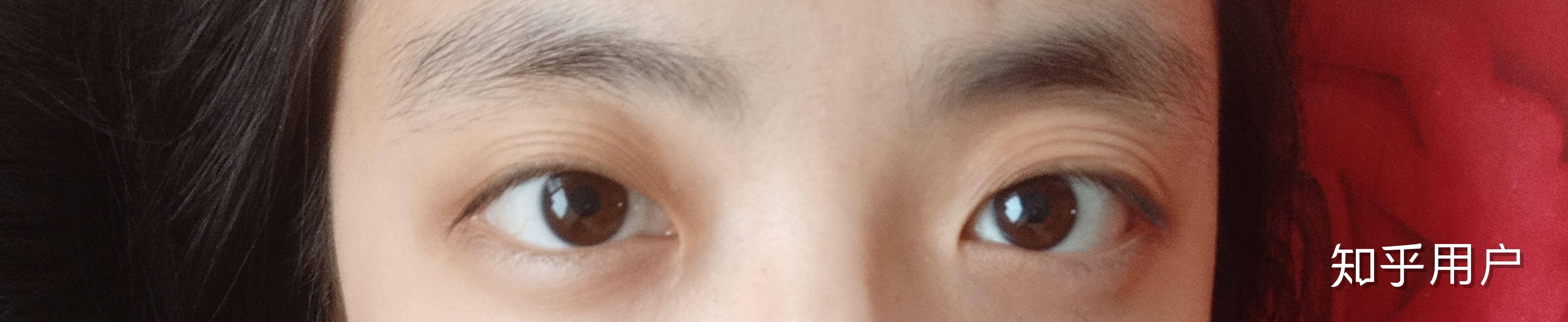 侧面看眼睛非常突眉骨低和鼻子连接不起来是怎么回事