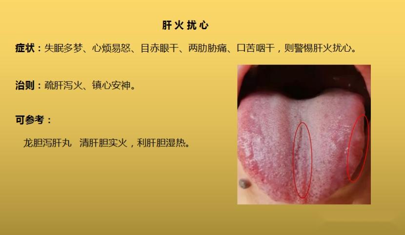 4种“热”藏于体内,不同舌象,不同症状,建议收藏分享给朋友 - 知乎