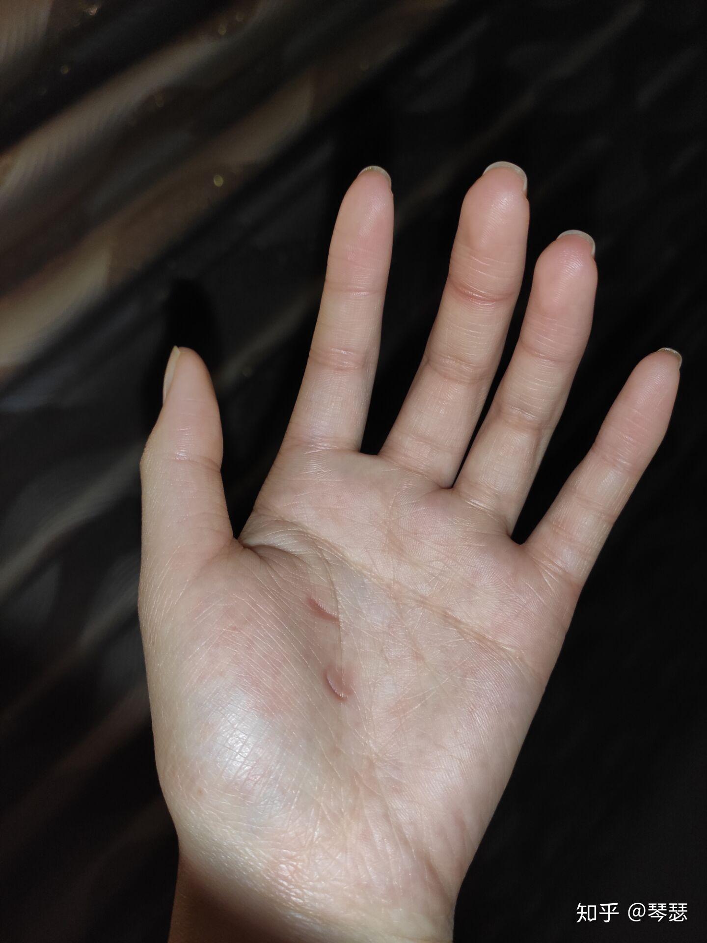 睡觉中经常会紧握住手成拳头状醒后发现指甲掐的手心很深的印是怎么