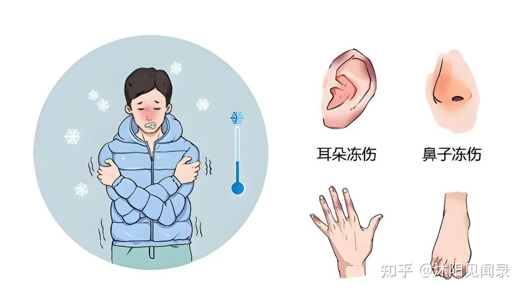 冻伤如何处理 - 知乎