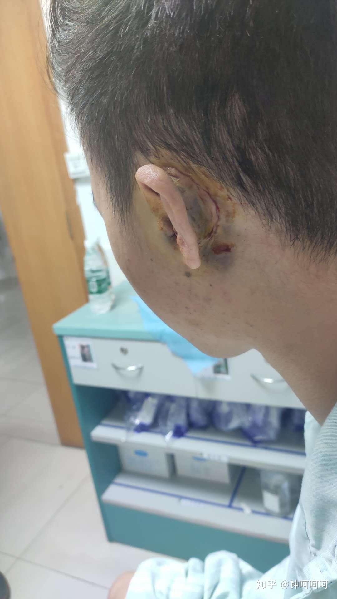 做过外耳道胆脂瘤或中耳胆脂瘤手术的人现在都怎么样了