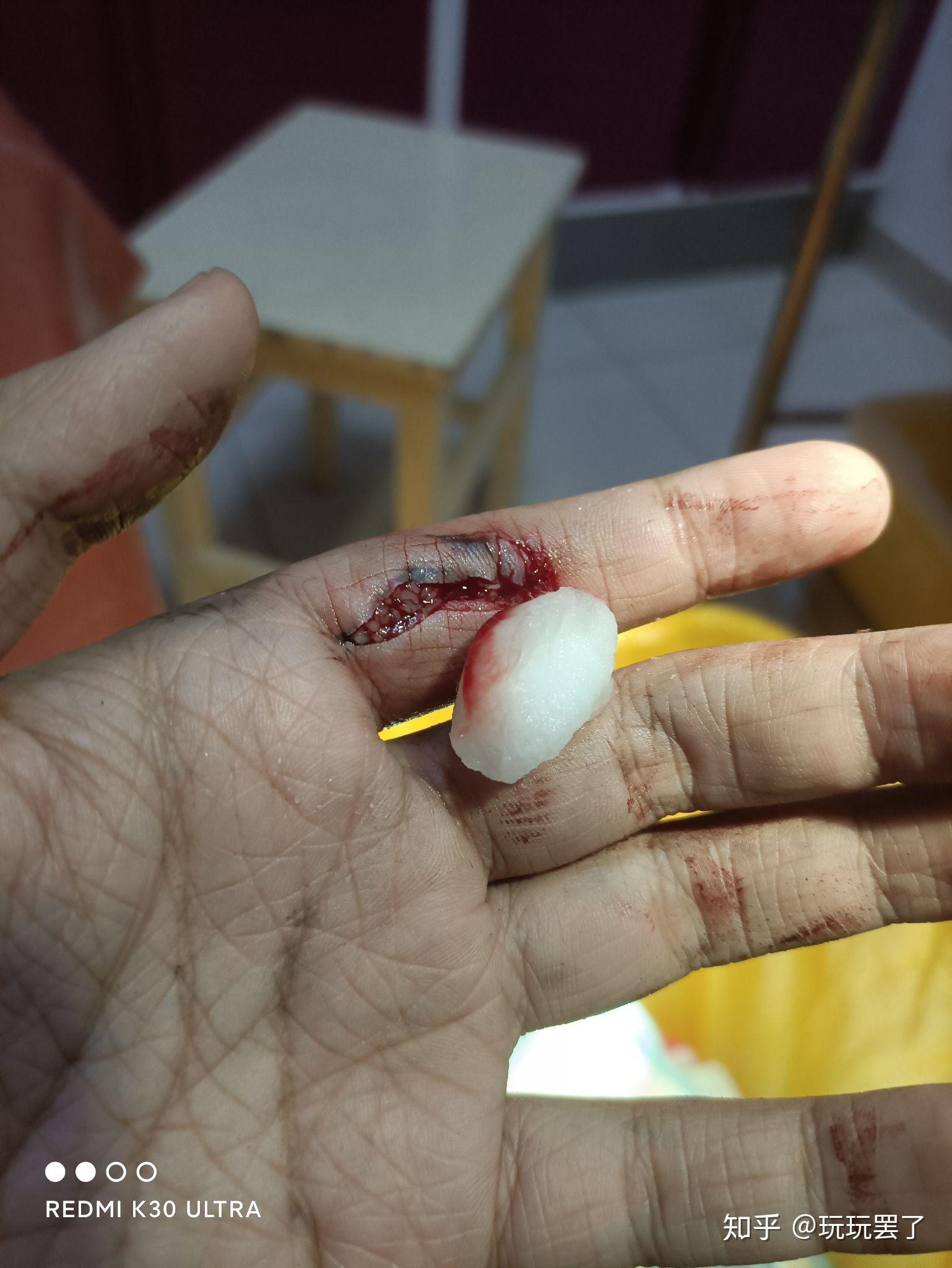 伤口拆线的时候疼吗