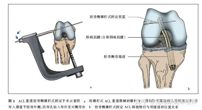 膝关节前叉韧带断裂手术用哪种韧带好人工韧带能用多久? - 知乎