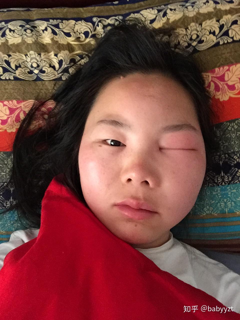 为什么被蜜蜂蛰了会起包被蜇后该怎么办