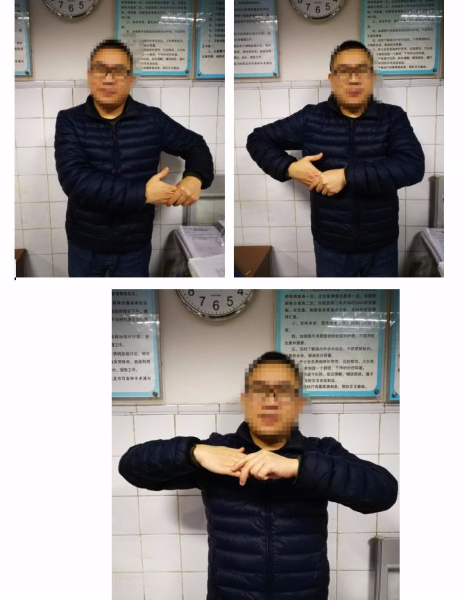 肱骨近端骨折术后如何康复训练? - 知乎