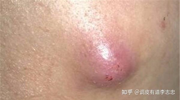 不起眼的小药——冰硼散，却有16种妙用，赶紧收藏！ - 知乎