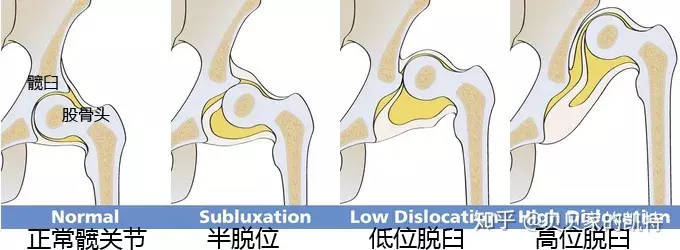 成人先天性髋关节发育不良(髋臼发育不良)? - 知乎