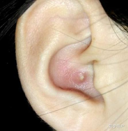 耳朵里长痘痘是一种什么体验? 
