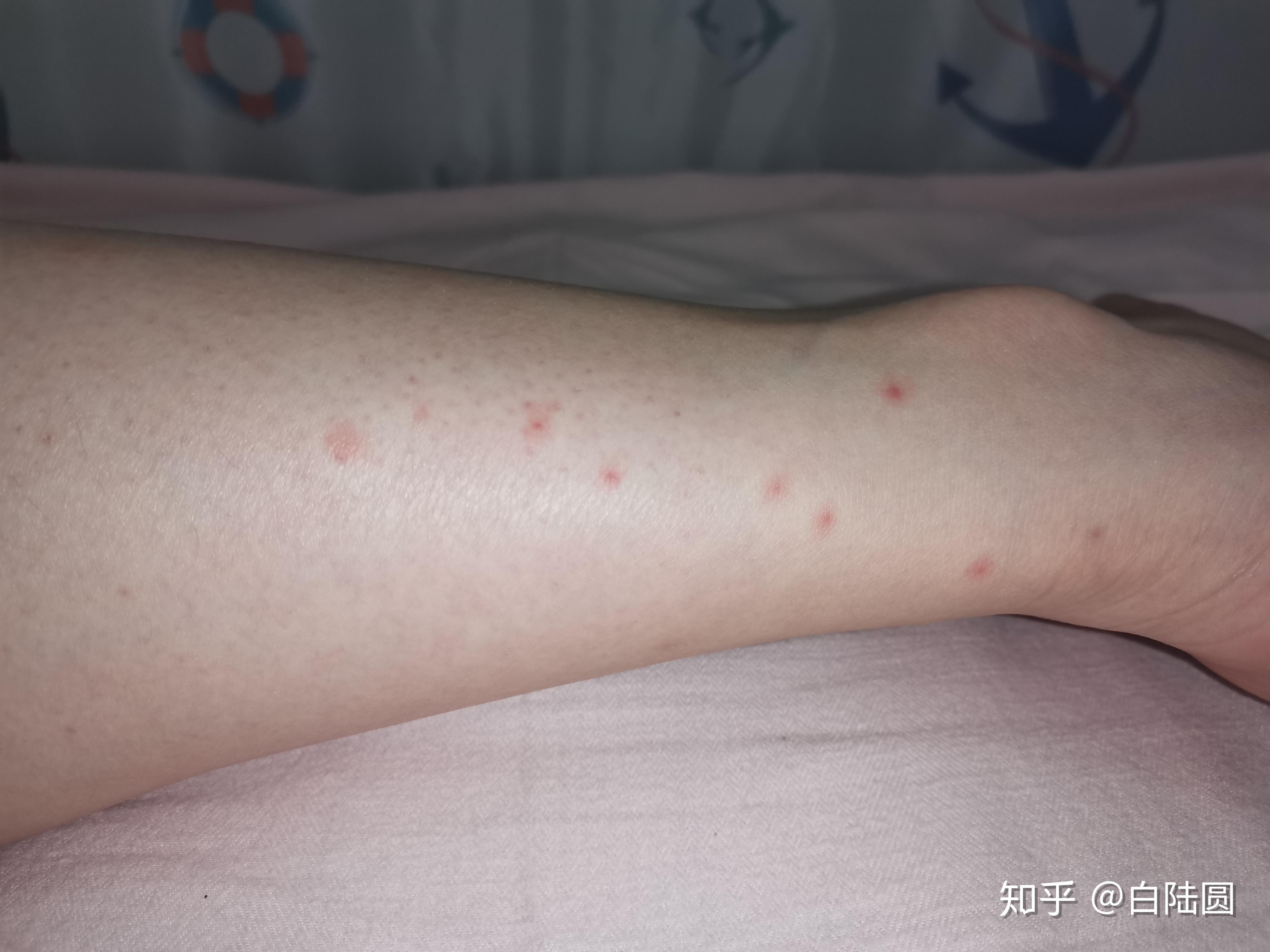 为什么我被蚊子咬了不起包,只有一个小红点,是什么原因? 