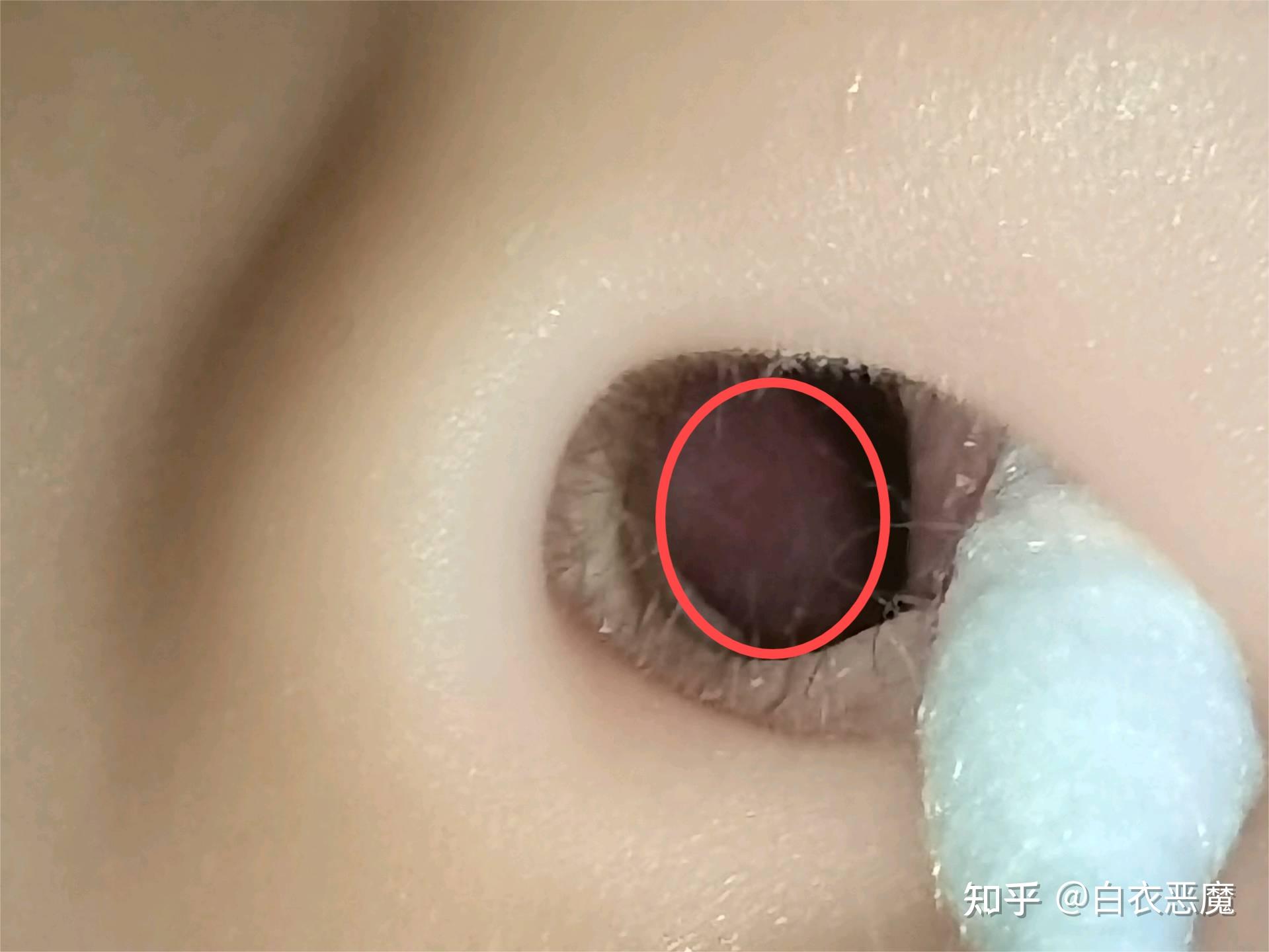 鼻孔里面肿了并出现白色脓包,周围红肿,应该怎么治疗?