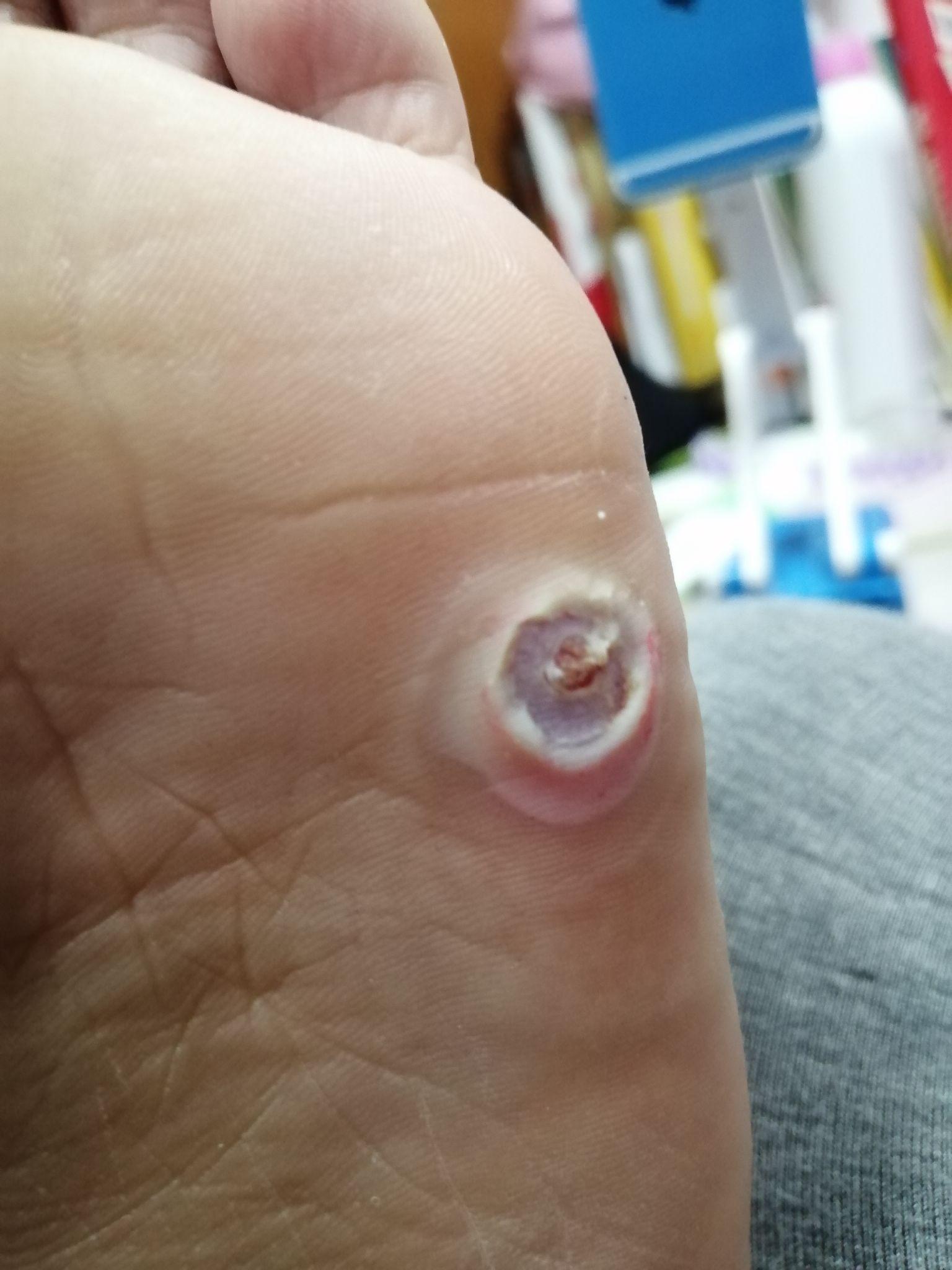 室友挖鸡眼是一种怎样的体验? - 知乎