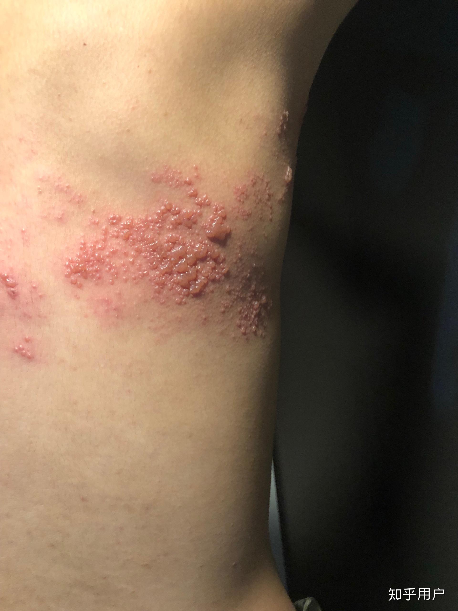 什么是神经性带状疱疹有办法医治吗