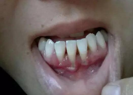 牙龈萎缩,牙缝变大还能治好吗?