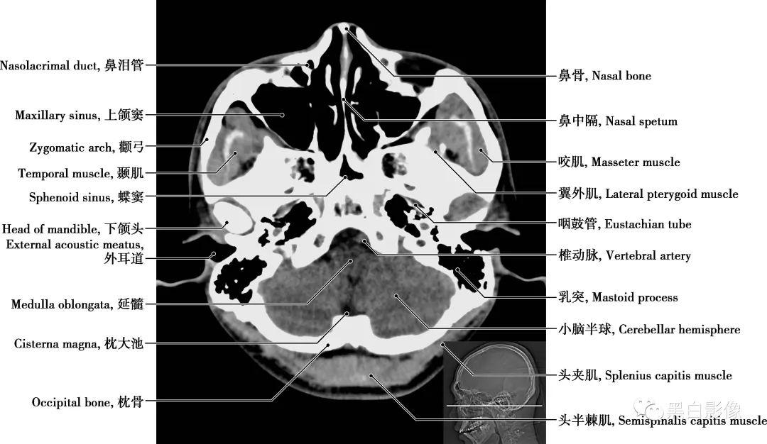 详细标注版!颅脑CT正常解剖图谱 - 知乎
