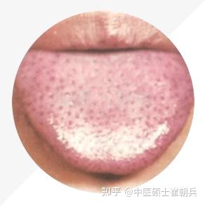 史上最全舌诊图谱！【珍藏版】 - 知乎