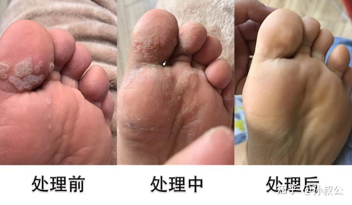 腳上長病毒疣怎麼治