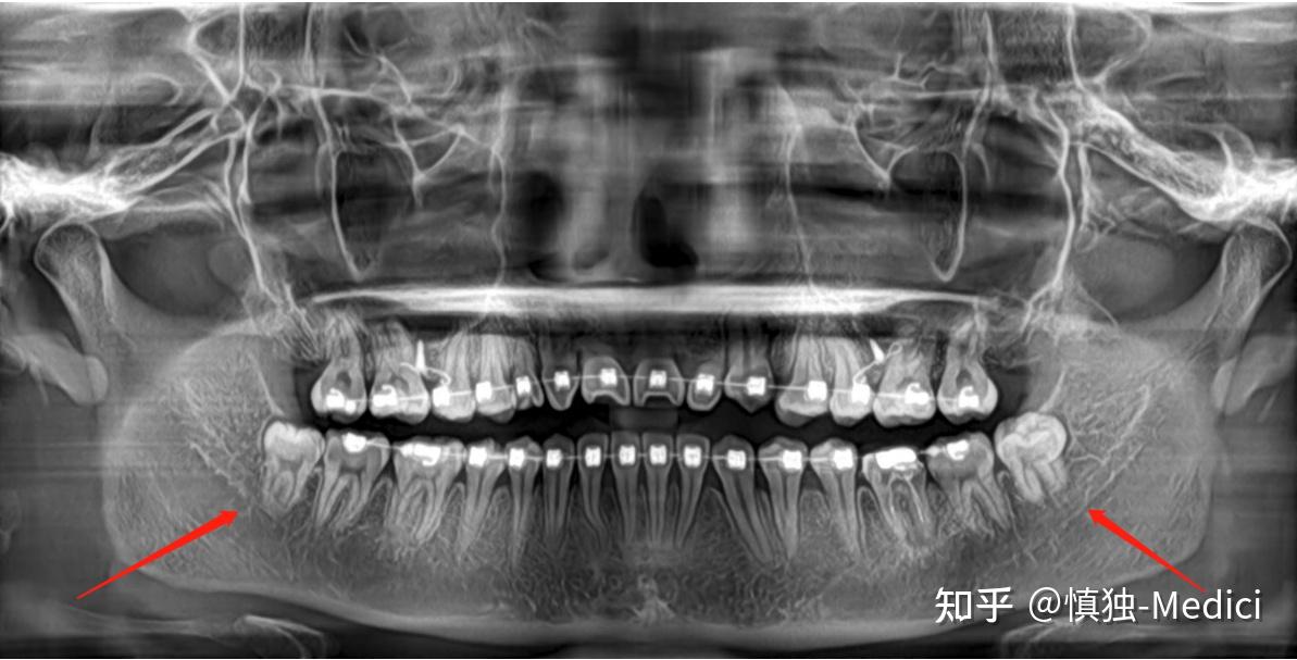 颏神经、智齿拔除风险与下巴麻木 - 知乎