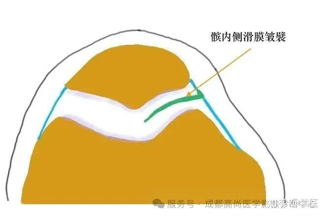 膝关节滑膜皱襞综合征(MPS)MR诊断 - 知乎