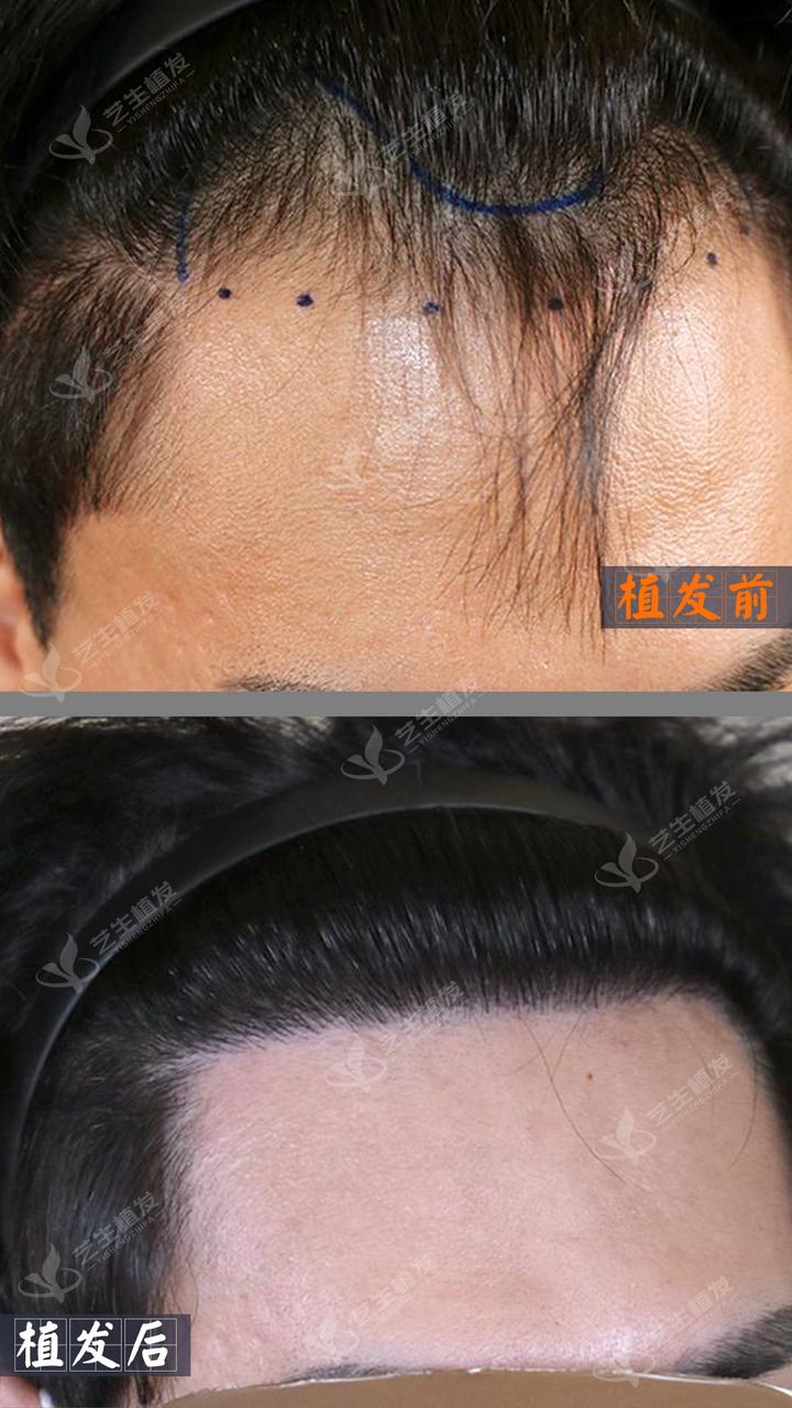 发际线额角种植自然浓密更自信鼓掌676767