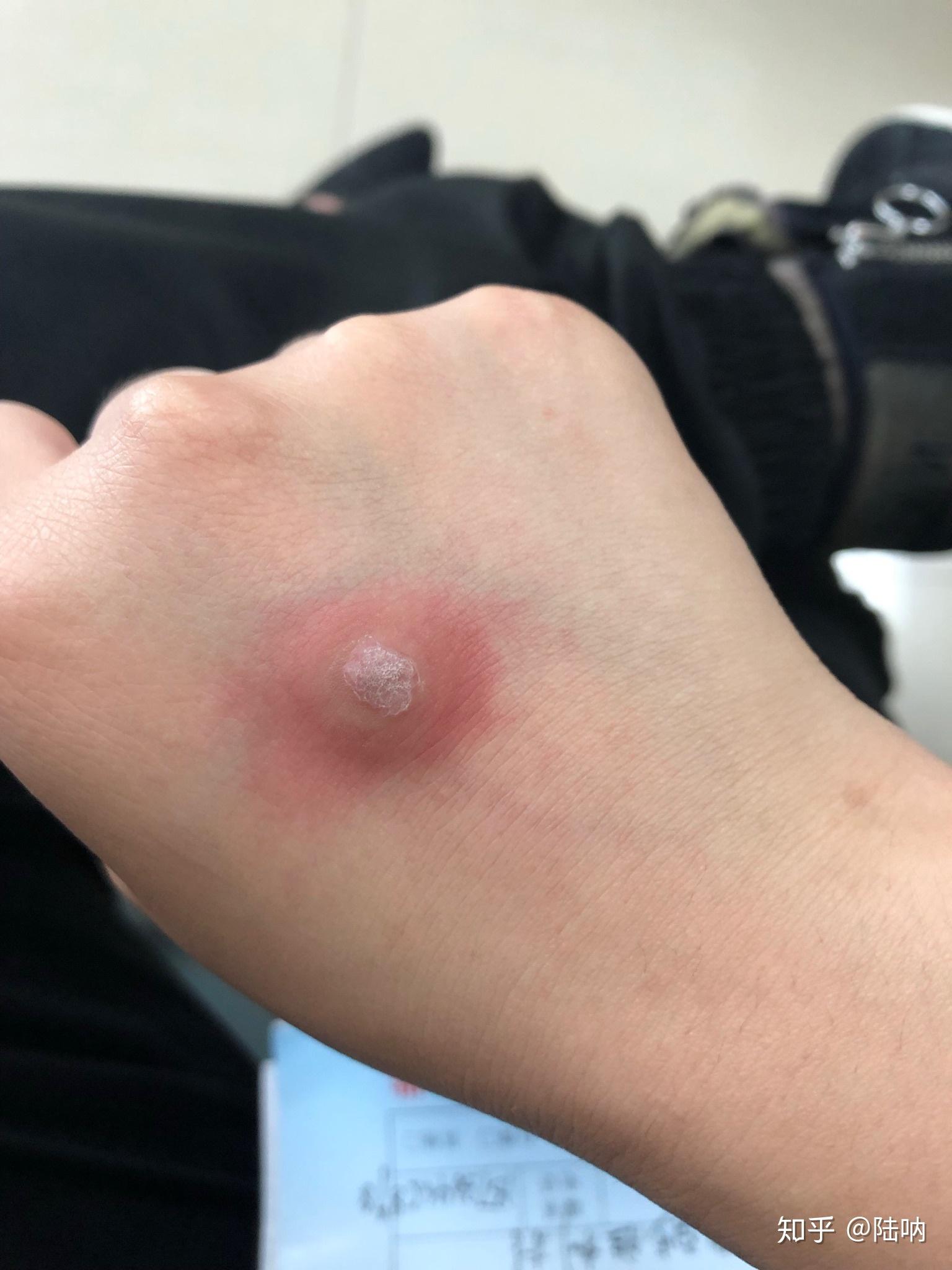 甲下寻常疣做液氮冷冻疼哭了可耐受疼痛真的这么厉害吗还是我太弱了