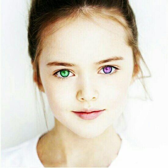 现实中人类异色瞳/虹膜异色症的概率是多少? - 知乎