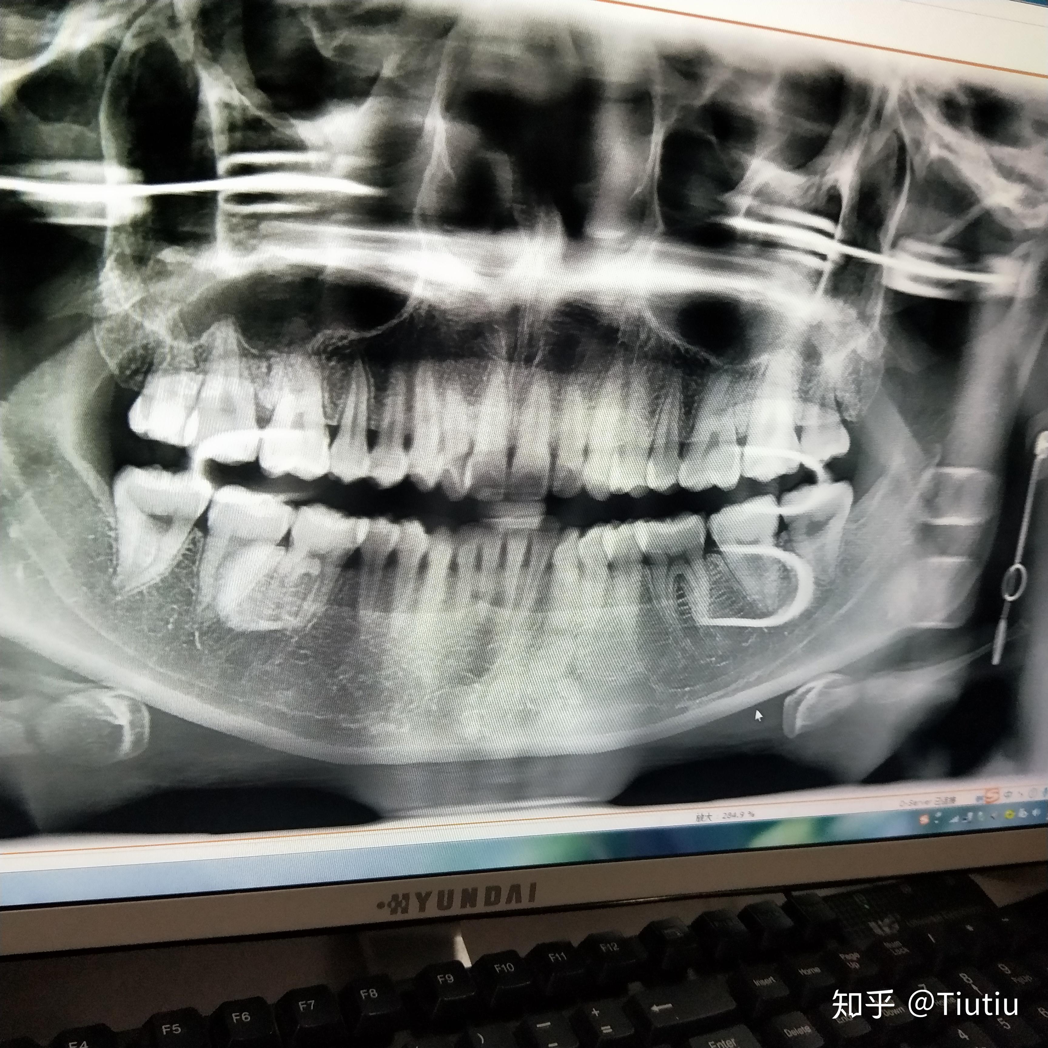 智齿长得很好即正位不痛是什么体验