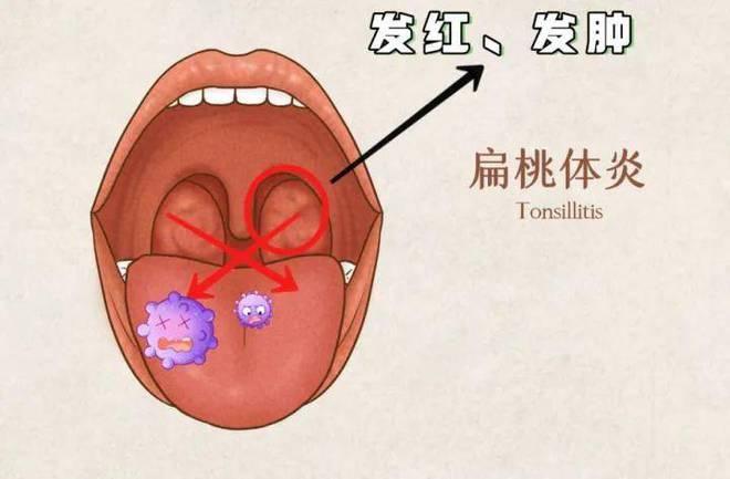扁桃体老发炎,要不要切除呢? - 知乎