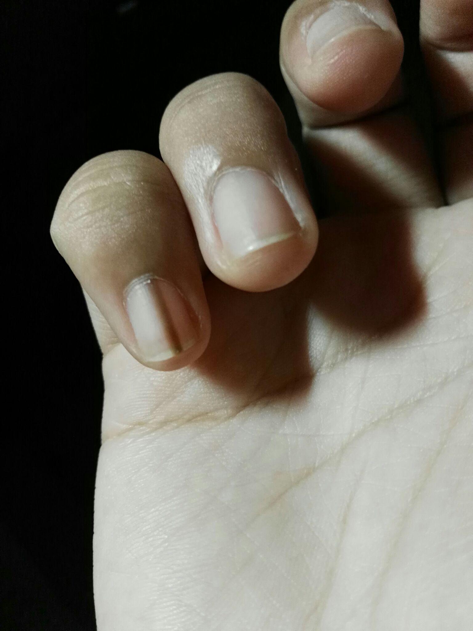 手指甲中间有一条深褐色纹路说明什么? - 知乎