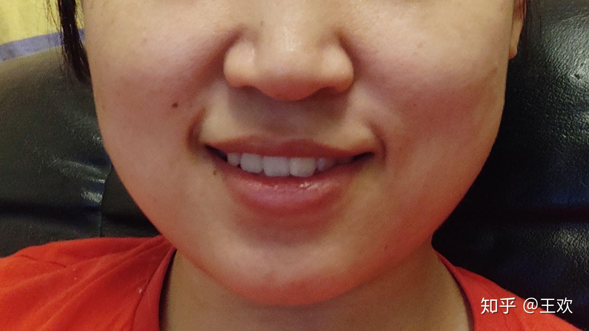 笑起来嘴角会有两道纹,但不是法令纹,有的人也会有,但一直不知道叫