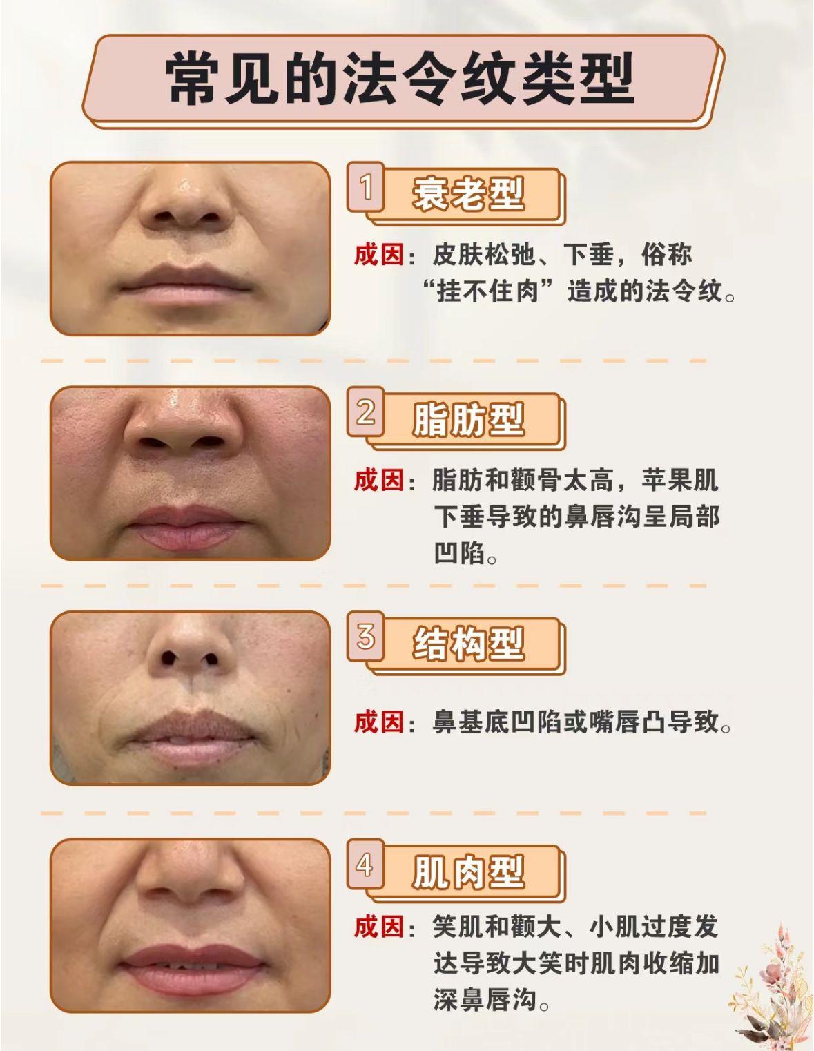 法令纹这个“钉子户”有多无解,只有真花了心思和钱去改善的朋友才懂,越努力越不幸,太难搞了! - 知乎