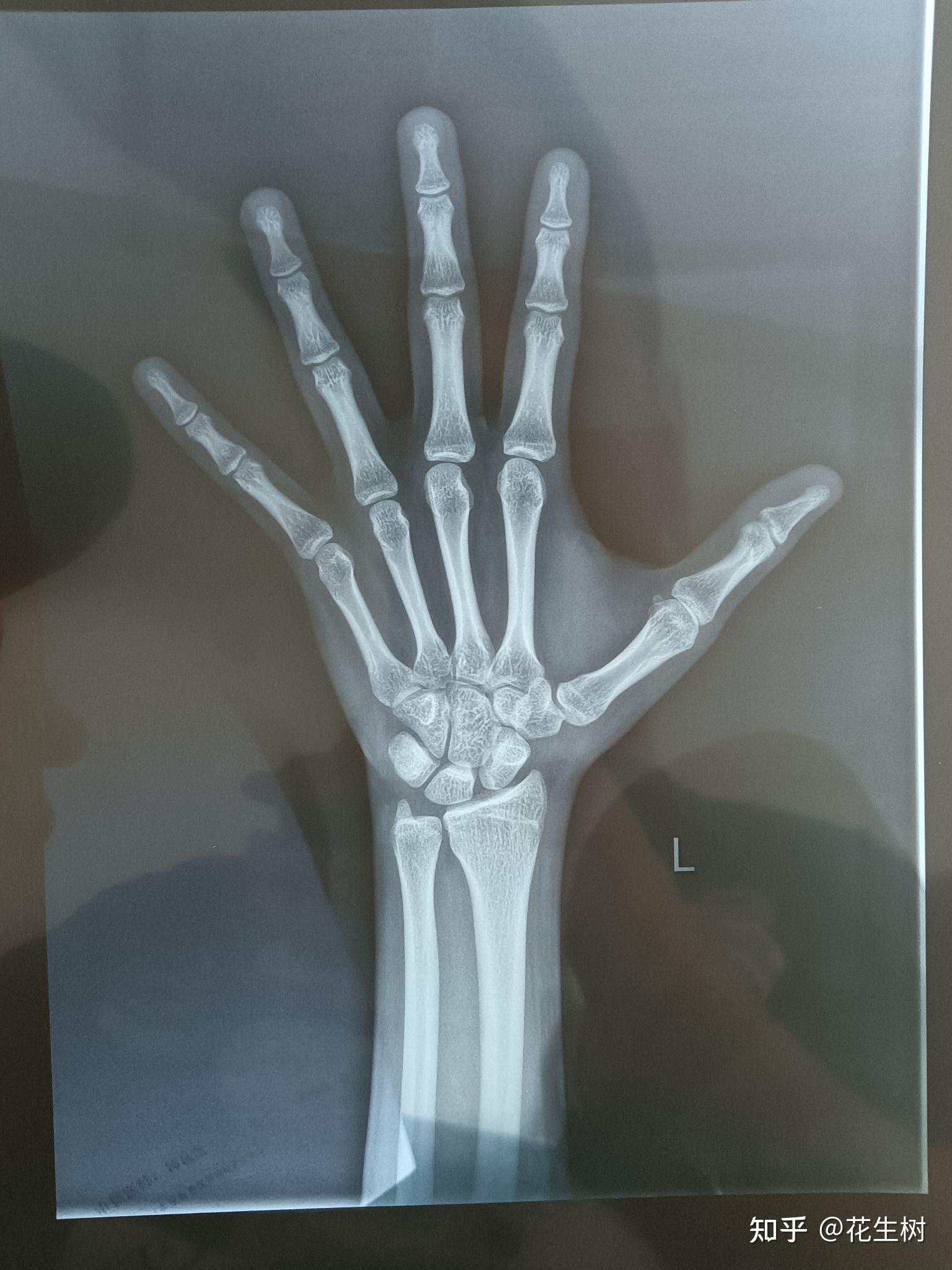 知友们,我拍了一张手腕x光片,大家能帮我看看骨骼线闭合了吗,还能长