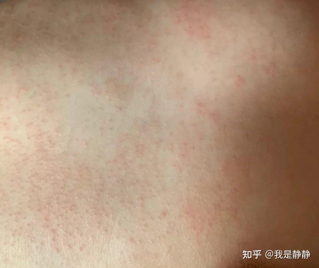 辅食过敏有哪些表现