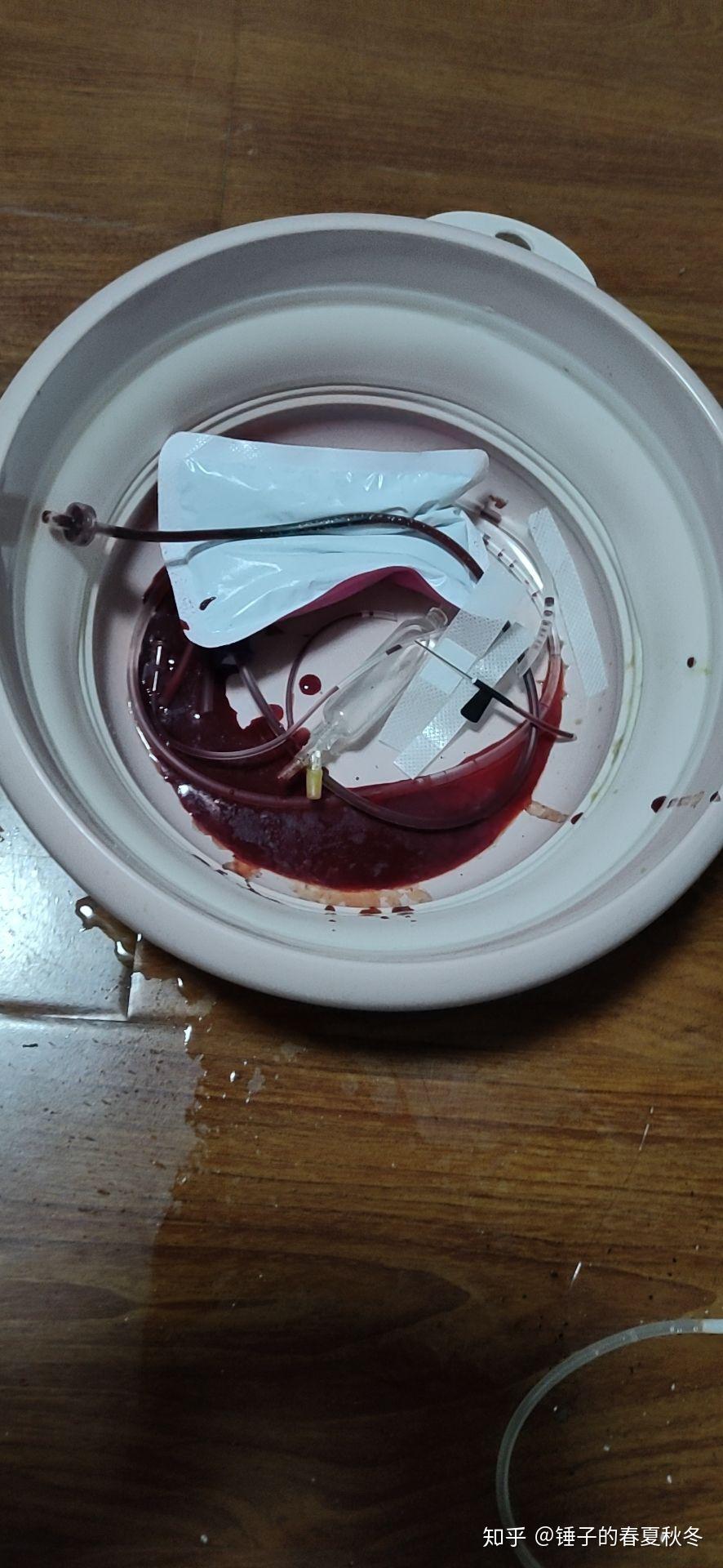 使用输液器扎入静脉放血会因为失血过多而死亡吗如果是需要多长时间