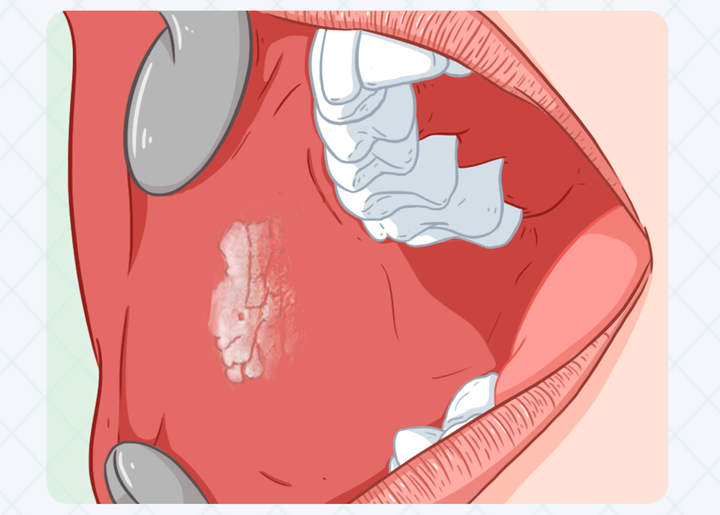 口腔白斑图晚期图片