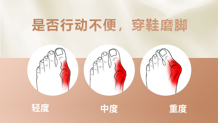 郝雨生解说,拇外翻为什么会遗传女孩? - 知乎