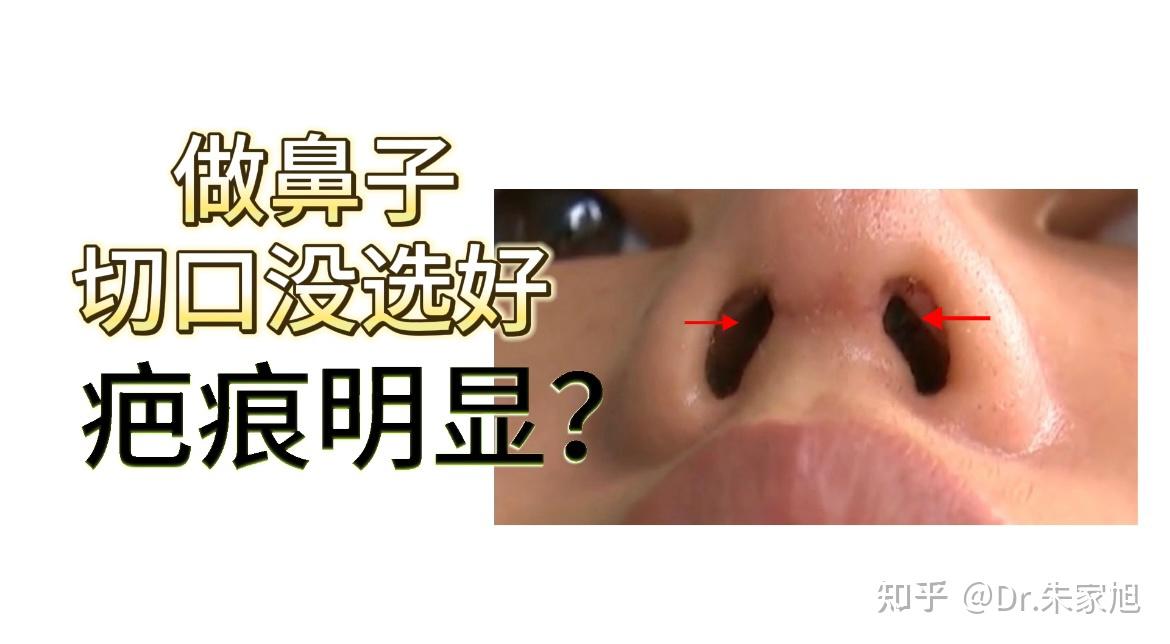 做鼻子,切口没选好,疤痕明显? - 知乎