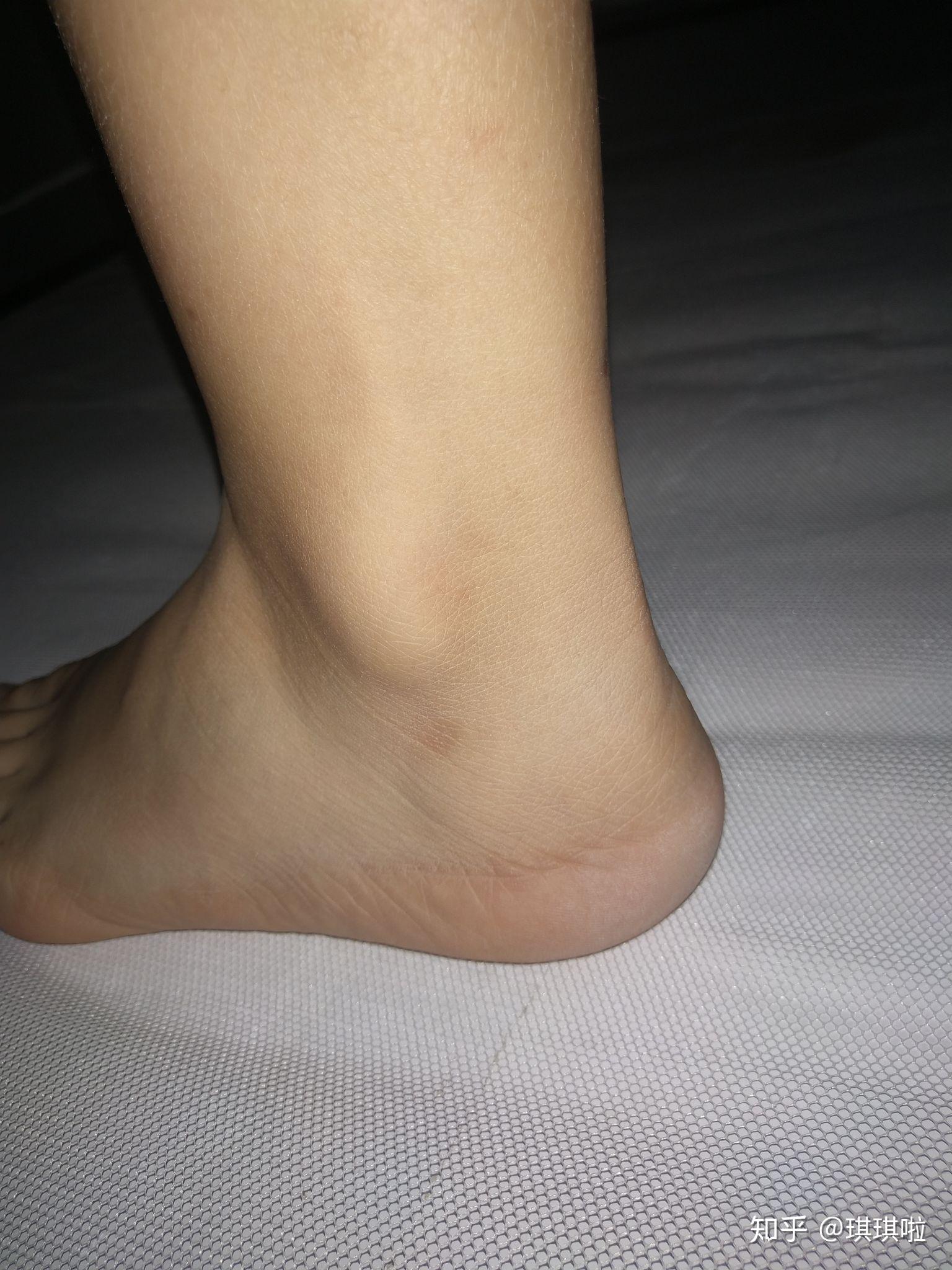 女生脚踝粗是基因决定的吗